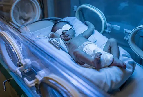 Newborn baby receiving phototherapy treatment at home